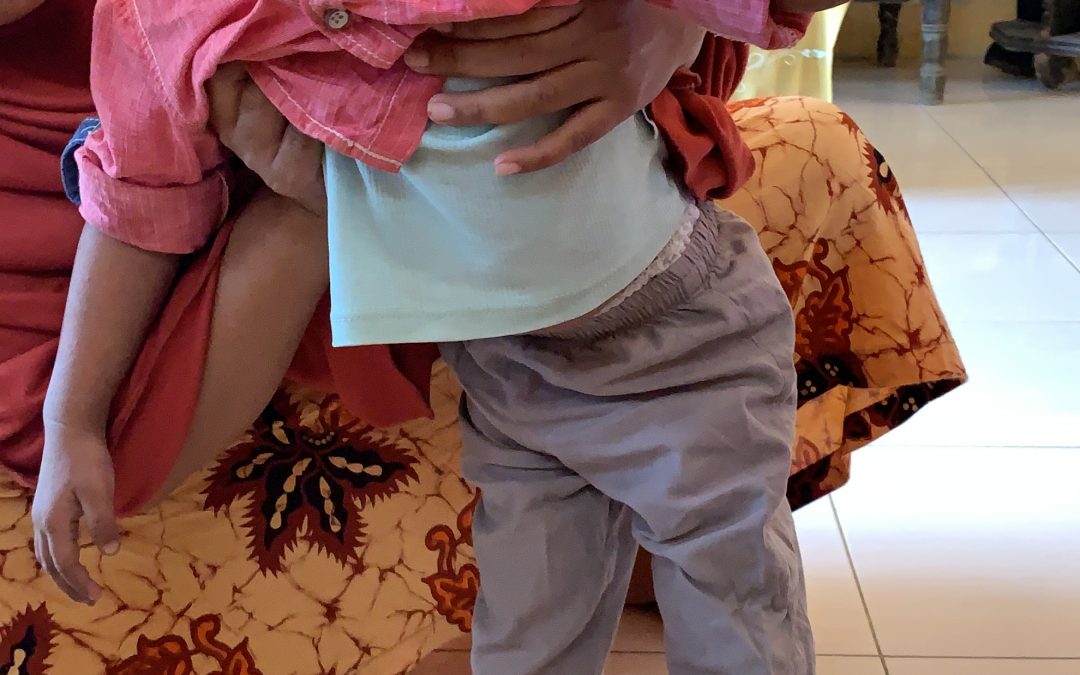 Pilu, piatu usia 2,5 tahun ini harus menanggung sakit di punggungnya tanpa bisa berobat.